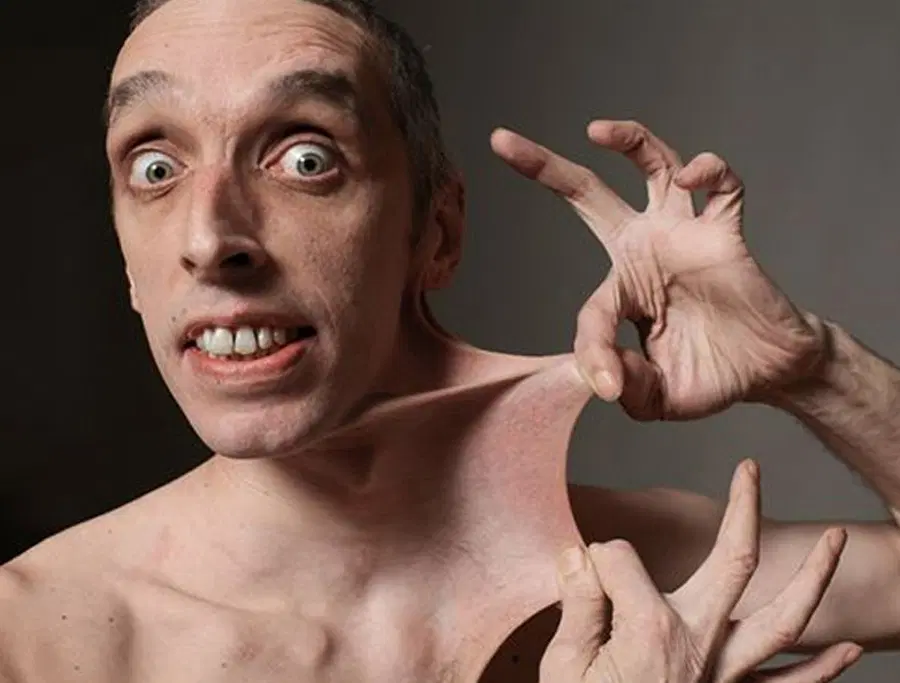 What are Ehlers-Danlos Syndromes?