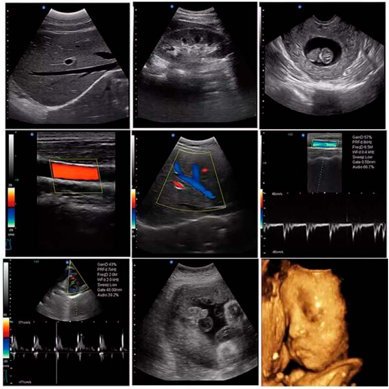 Color Doppler YR05150 – 1